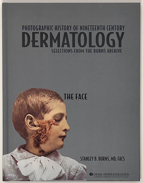 Photographic History of Nineteenth Century Dermatology:Selections From the Burns Archive (SIGNED)by: Burns, MD, FACS, Stanley B.